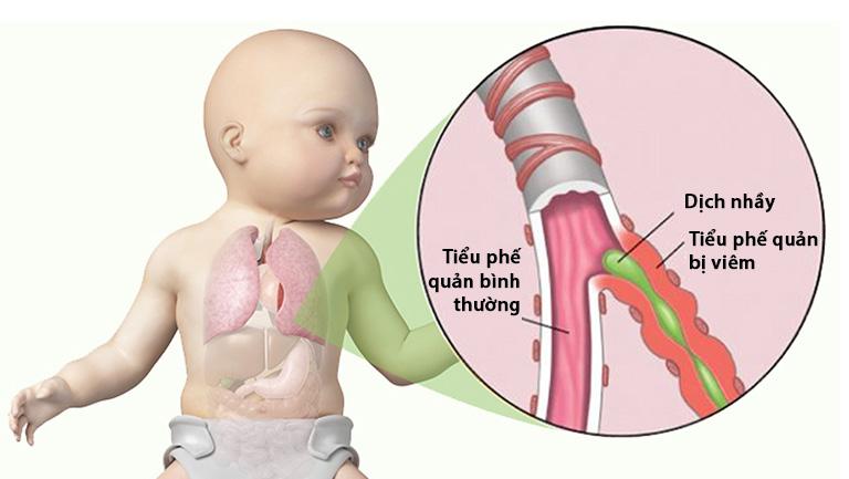 Trẻ bị viêm tiểu phế quản có nên dùng kháng sinh?  - Ảnh 1.