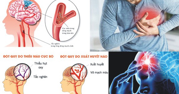 4 việc cần làm ngay khi ngủ dậy để phòng ngừa đột quỵ