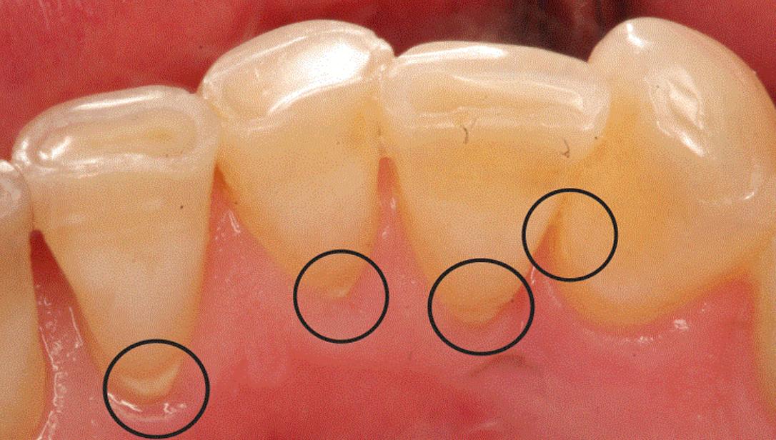 7 cách loại bỏ cao răng tại nhà - Ảnh 1.