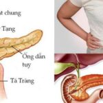 Người đàn ông ở Phú Thọ nhập viện gấp vì mỡ máu cao gấp 50 lần, bác sĩ khuyến cáo từ bỏ ngay thói quen này