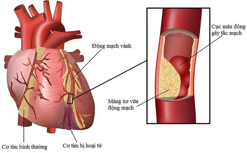 Nhồi máu cơ tim khác với đột quỵ về nguyên nhân và triệu chứng - Công ty cổ phần y khoa UNI CARE Nha Trang