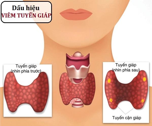 Những vấn đề thường gặp sau phẫu thuật tuyến giáp - Ảnh 1.