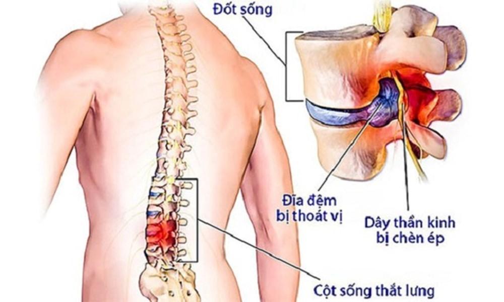 5 nguyên nhân gây thoát vị đĩa đệm mà ai cũng nên biết - Ảnh 2.