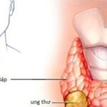 Các dấu hiệu điển hình của ung thư tuyến giáp ai cũng cần biết