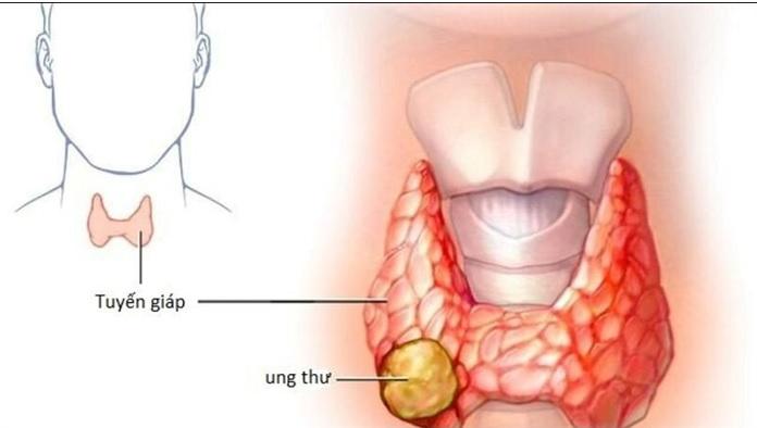 Những dấu hiệu điển hình của ung thư tuyến giáp mà ai cũng cần biết - Ảnh 1.