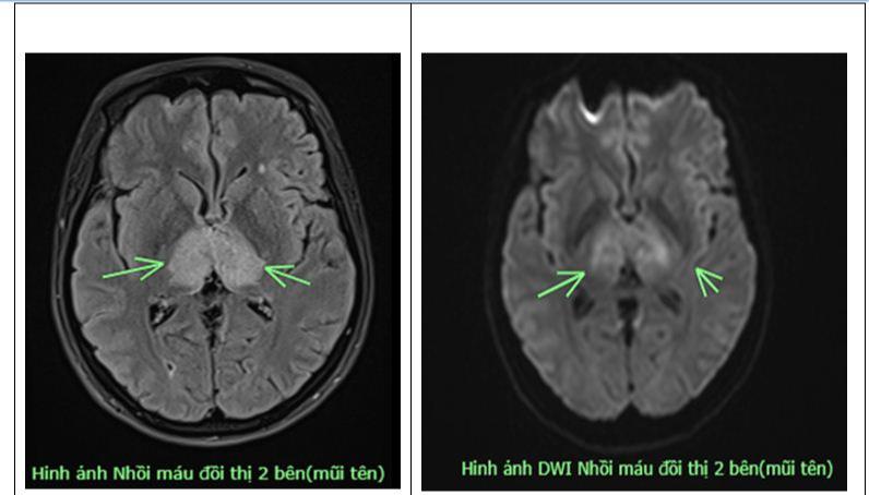 Đau đầu 4 ngày không uống thuốc, người phụ nữ 38 tuổi mắc bệnh não nguy hiểm - Ảnh 1.