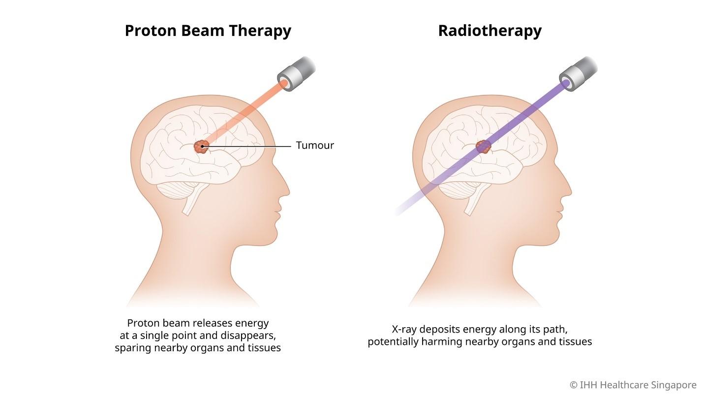 Liệu pháp nhắm mục tiêu trong điều trị ung thư sử dụng độ chính xác của chùm proton - Ảnh 2.