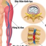 Đau thần kinh tọa - Nguyên nhân và cách hỗ trợ cải thiện