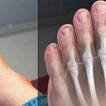 Điều trị bệnh gout cần lưu ý 3 điều sau