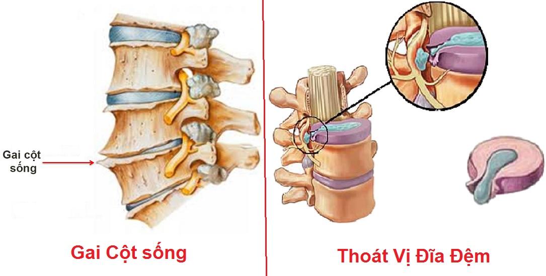 Thoát vị đĩa đệm là tình trạng nhân nhầy giữa các đốt sống thoát ra khỏi các sợi xung quanh.