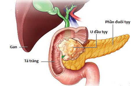 Người đàn ông 30 tuổi bất ngờ phát hiện ung thư tuyến tụy thừa nhận sai lầm nhiều người Việt mắc phải - Ảnh 2.