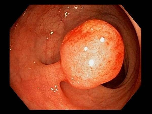 Polyp dạ dày có nguy cơ bị ung thư không? - Ảnh 1.