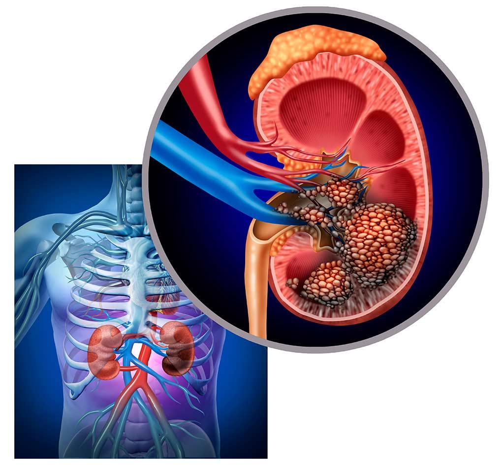 Giảm cân nhanh có phải là ung thư thận? - Ảnh 1.