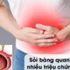 Người đàn ông 49 tuổi ở Phú Thọ nhập viện gấp, tăng nguy cơ suy thận do sỏi bàng quang gây tắc nghẽn đường tiểu