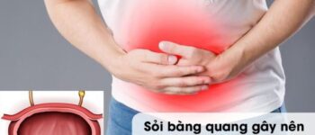 Người đàn ông 49 tuổi ở Phú Thọ nhập viện gấp, tăng nguy cơ suy thận do sỏi bàng quang gây tắc nghẽn đường tiểu