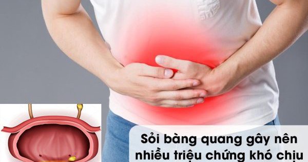 Người đàn ông 49 tuổi ở Phú Thọ nhập viện gấp, tăng nguy cơ suy thận do sỏi bàng quang gây tắc nghẽn đường tiểu