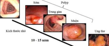 Người đàn ông ở Phú Thọ phát hiện mắc ung thư trực tràng từ một dấu hiệu nhiều người Việt bỏ qua