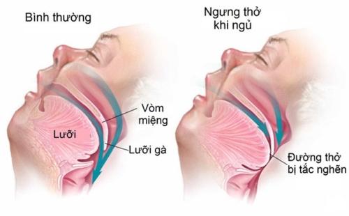 Thường buồn ngủ ban ngày, ngáy, mệt mỏi khi thức dậy, bạn nên chú ý tới hội chứng nguy hiểm này - Ảnh 1.