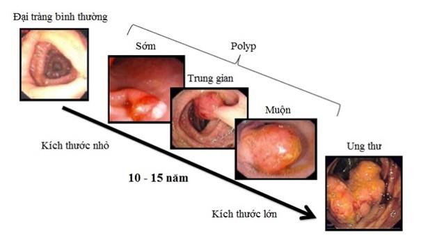 Một người đàn ông ở Phú Thọ được phát hiện mắc ung thư trực tràng từ dấu hiệu nhiều người Việt bỏ qua - Ảnh 2