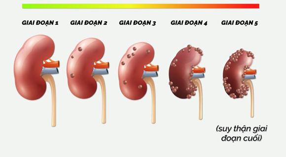 Suy thận giai đoạn 3 gây tiểu đêm nhiều, phù chân – Hỗ trợ thế nào hiệu quả? - Ảnh 1.