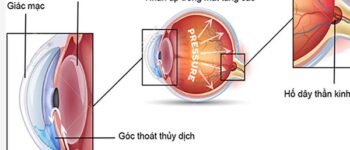 6 bước ngăn ngừa tăng nhãn áp gây hại thêm cho thị lực