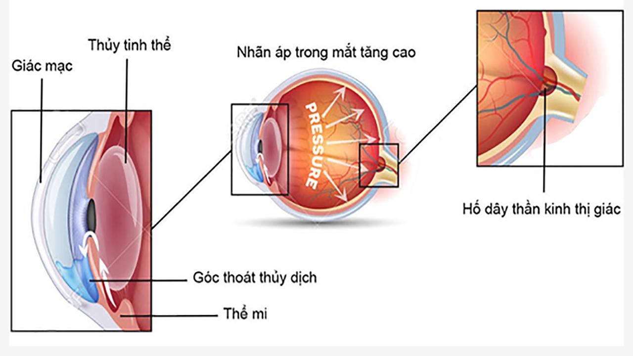 6 bước ngăn ngừa bệnh tăng nhãn áp làm tổn hại thêm thị lực - Ảnh 1