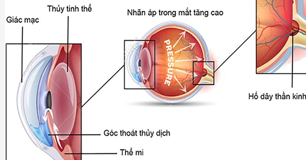 6 bước ngăn ngừa tăng nhãn áp gây hại thêm cho thị lực