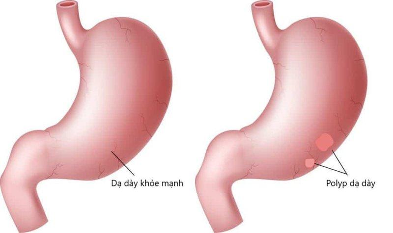 Polyp dạ dày có nguy hiểm không? - Ảnh 2.