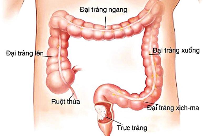 Ung thư đại trực tràng, ai cần tầm soát sớm? - Ảnh 1.