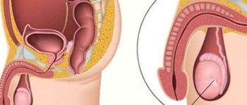 Bé trai 11 tuổi đã mắc ung thư tinh hoàn, chuyên gia cảnh báo dấu hiệu phát hiện sớm bệnh