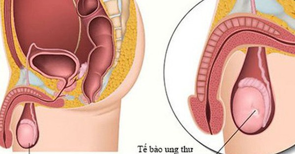 Bé trai 11 tuổi đã mắc ung thư tinh hoàn, chuyên gia cảnh báo dấu hiệu phát hiện sớm bệnh