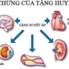 Người phụ nữ 35 tuổi ở Hà Nội bị suy thận, cao huyết áp thừa nhận một sai lầm nhiều người Việt mắc phải