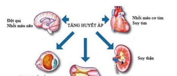 Người phụ nữ 35 tuổi ở Hà Nội bị suy thận, cao huyết áp thừa nhận một sai lầm nhiều người Việt mắc phải