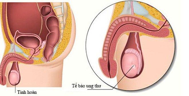 Bé trai 11 tuổi mắc ung thư tinh hoàn, chuyên gia cảnh báo dấu hiệu phát hiện sớm bệnh - Ảnh 1.