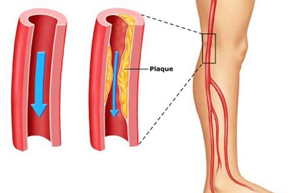 Đau chân khi đi lại cảnh giác bệnh động mạch chi dưới - Ảnh 1