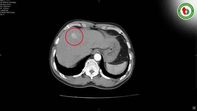 Một người đàn ông ở Phú Thọ may mắn phát hiện sớm khối u gan nhờ làm điều mà nhiều người Việt bỏ qua - Ảnh 2