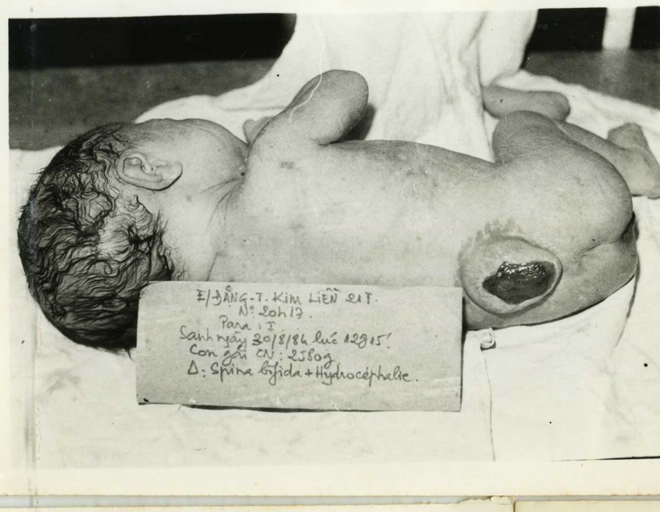 Dioxin gây dị tật bẩm sinh