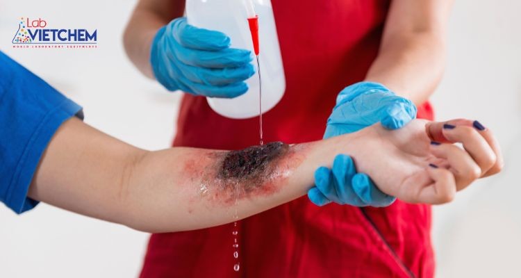 Axit Fluoroantimonic có thể gây bỏng da khi tiếp xúc