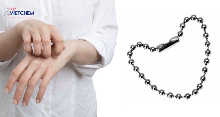 Dị ứng trang sức niken