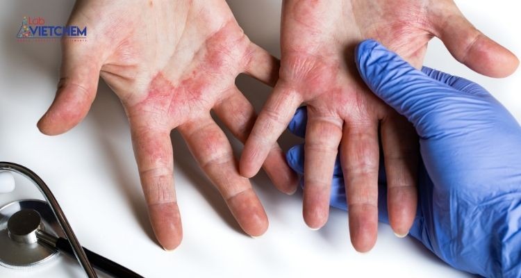 Propionic aldehyd có thể gây phồng rộp da