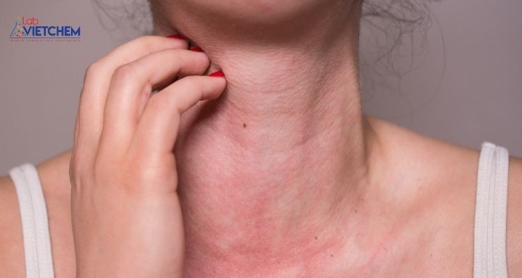 Triệu chứng dị ứng