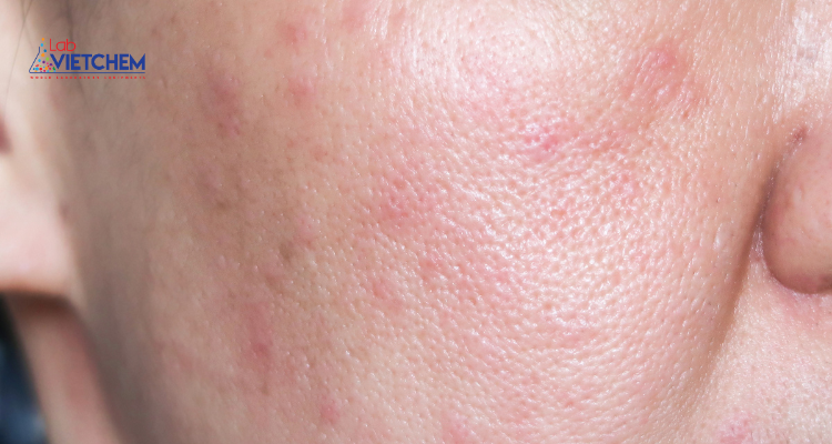 Dị ứng với mỹ phẩm có chứa Benzyl salicylate