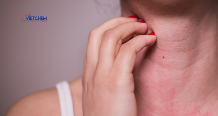 Tiếp xúc với các hợp chất sulfite có thể gây dị ứng