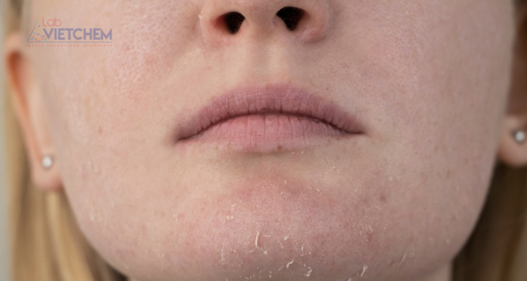 BHA bôi quá nhiều có thể gây châm chích, bong tróc da