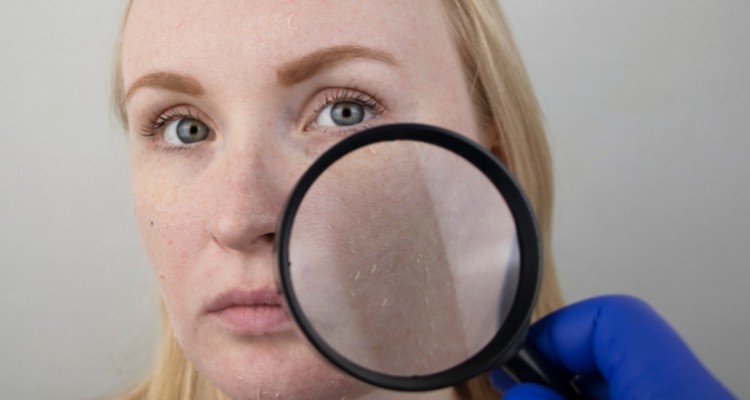 Tác dụng phụ khi dùng quá nhiều axit mandelic