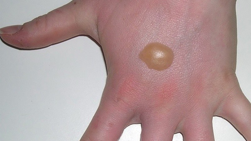 Chữa vết bỏng nhỏ