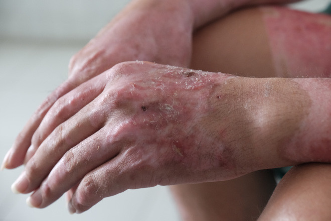   Xút tiếp xúc với cơ thể con người gây bỏng, mất thẩm mỹ