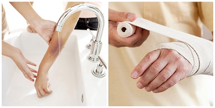 Khi bị bỏng bởi axit sunfuric, rửa vết bỏng dưới vòi nước chảy.