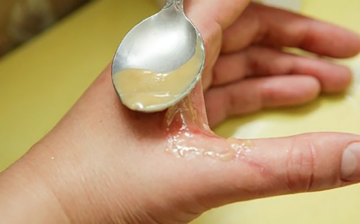 Không chữa bỏng axit sulfuric bằng kinh nghiệm dân gian