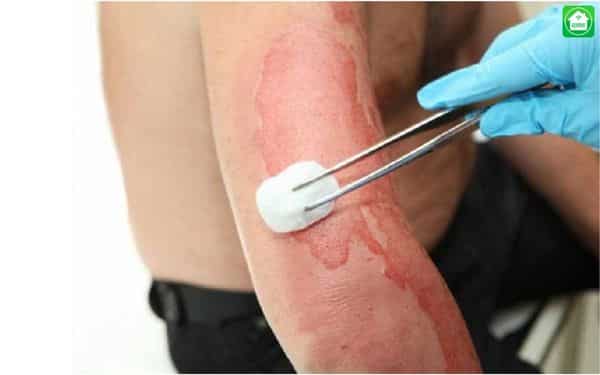 Cách Sử Dụng Điện An Toàn Bạn Cần Ghi Nhớ 10 Điều Này 2 Bỏng điện